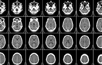 Obez çocukların beyinlerinde yapısal farklılıklar gözlendi