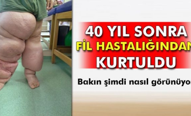 40 yıl sonra fil hastalığından kurtuldu