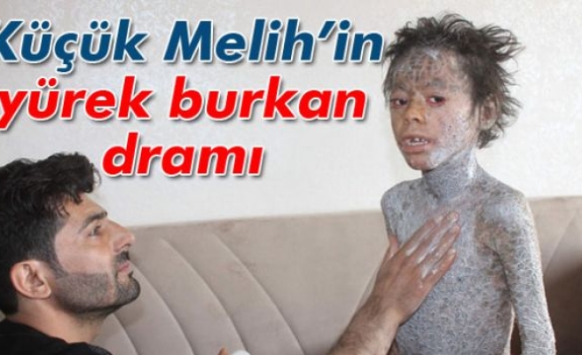 Küçük Melih’in dramı yürek burkuyor