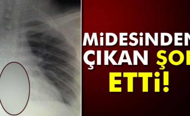 Midesinden 15 santimetrelik çatal çıktı