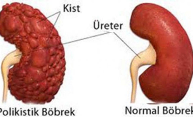 Polikistik böbrek hastalığı tedavi yöntemleri
