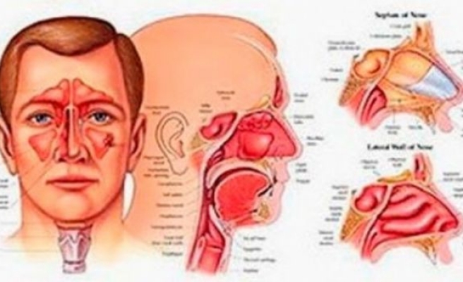 Sinüzit nedir neden olur