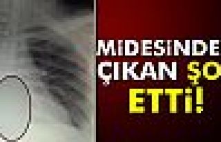 Midesinden 15 santimetrelik çatal çıktı