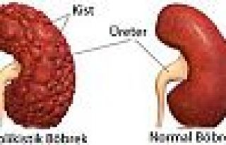Polikistik böbrek hastalığı tedavi yöntemleri